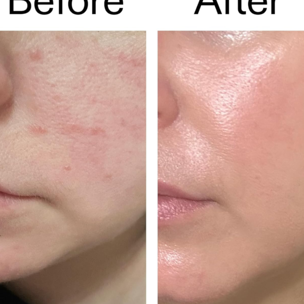 Fix skin texture in 14 days using this simple exosome serum
